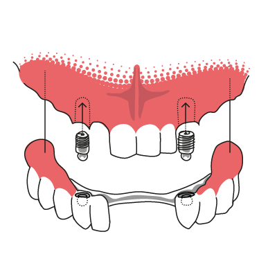 Veranschaulichung der Funktionsweise einer Druckknopfprothese, die auf Zahnimplantaten befestigt wird.
