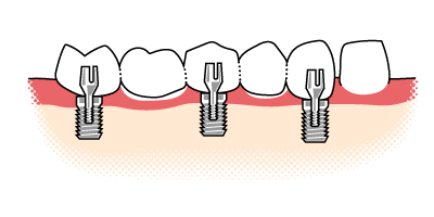 Veranschaulichung der des Aufbaus einer Implantatrücke auf zwei Implantaten und einem eigenen Zahn