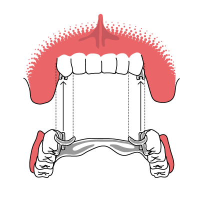 Geschiebeprothese, welche an den Eckzähnen befestigt ist und den linken und rechten Backenzahnbereich Oberkiefer versorgt.