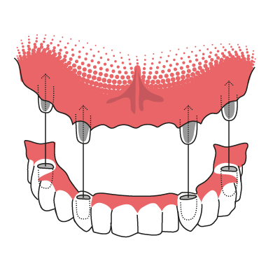 Veranschaulichung der Funktionsweise einer Teleskopprothese, die auf Zahnstümpfen befestigt wird.